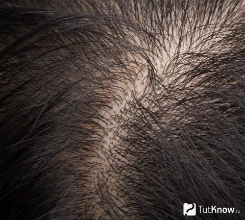 Советы трихолога по уходу за жирными волосами. Как бороться с жирными корнями волос? 10 Советы трихолога по уходу за жирными волосами. Как бороться с жирными корнями волос? 10