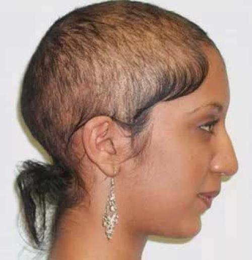 Как предотвратить выпадение волос у женщин в домашних условиях. Виды выпадения волос