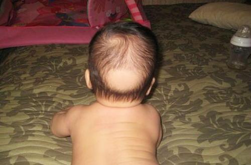 Выпадение волос у детей. С чем это может быть связано?