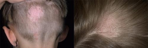 Выпадение волос у детей. С чем это может быть связано?