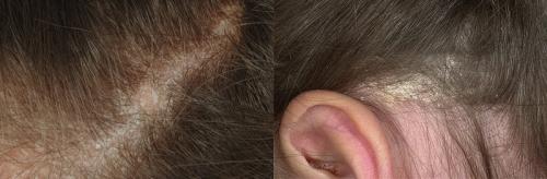 Выпадение волос у детей. С чем это может быть связано?