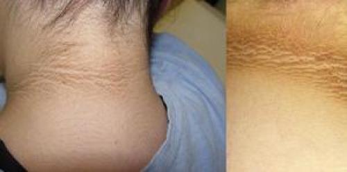 Чешется голова и шея сзади. Причины зуда на коже шеи