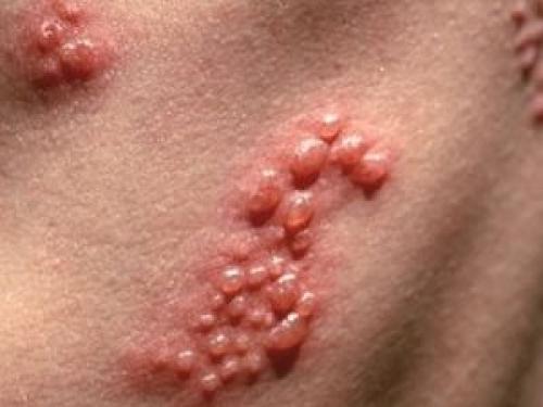 От чего на голове бывают болячки. Язвочки на голове: возможные причины появления 03 От чего на голове бывают болячки. Язвочки на голове: возможные причины появления 03