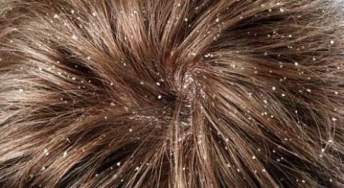 Как избавиться от перхоти лекарства. Лекарства от перхоти в аптеке