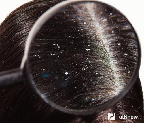 Перхоть, как избавиться в домашних условиях быстро. Яичные маски 09