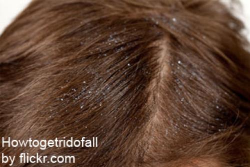 Лекарство от перхоти. Как подобрать лечебный шампунь от перхоти в аптеке