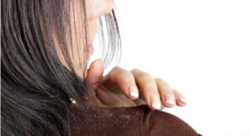 Как избавиться от перхоти в домашних условиях подростку. Лечение: традиционные методы
