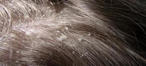 Как быстро убрать перхоть с волос. Причины возникновения перхоти