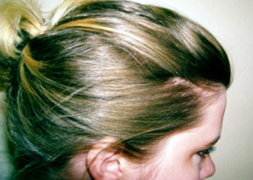 Дерматолог лечение перхоти. Лечение народными средствами