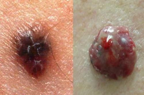 Маленькие бугорки на коже головы. Злокачественные