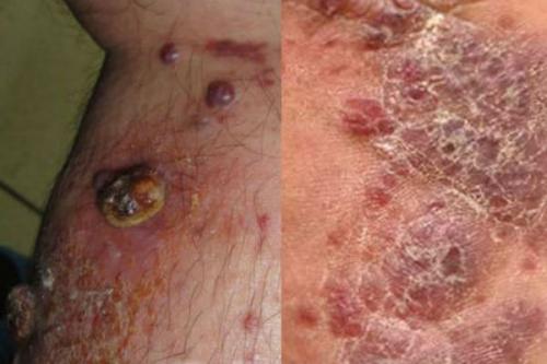 Маленькие бугорки на коже головы. Злокачественные