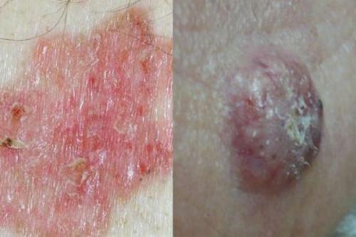 Маленькие бугорки на коже головы. Злокачественные