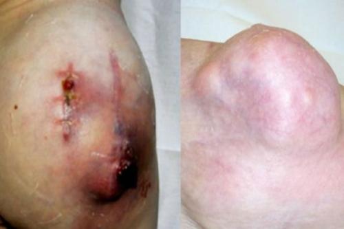 Маленькие бугорки на коже головы. Злокачественные