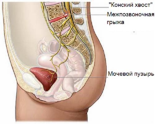 Конский хвост. Симптомы и лечение синдрома конского хвоста в пояснице