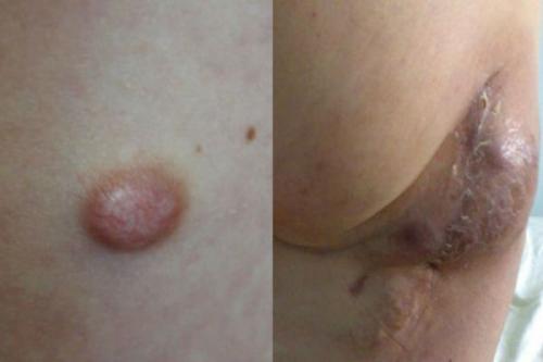 Маленькие бугорки на коже головы. Злокачественные