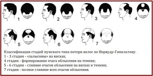 Почему выпадают волосы у мужчин. Причины выпадения волос у мужчин
