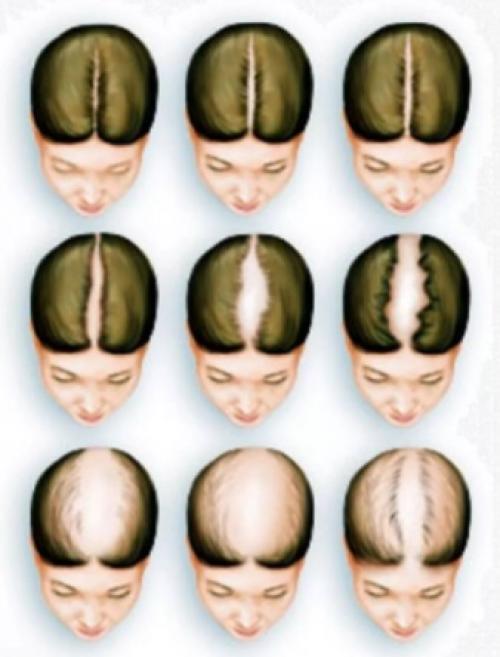 Алопеция гнездная лечение. Лечение гнездной алопеции 02 Алопеция гнездная лечение. Лечение гнездной алопеции 02