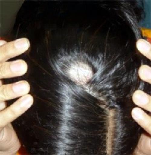 Алопеция гнездная лечение. Лечение гнездной алопеции 01 Алопеция гнездная лечение. Лечение гнездной алопеции 01