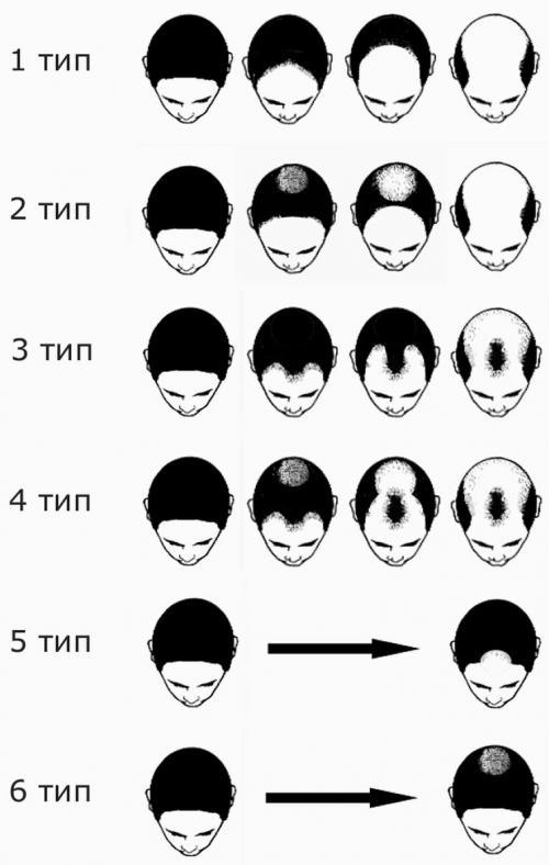Алопеция у детей. Виды, причины, диагностика и лечение алопеции у детей