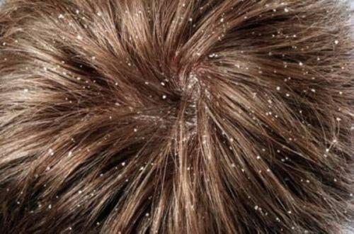 Тыквенное масло при облысении. Польза тыквенного масла