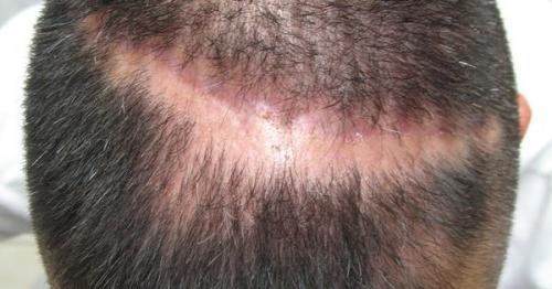 Для тонких и ослабленных волос и жирной кожи головы. Применение масок 10