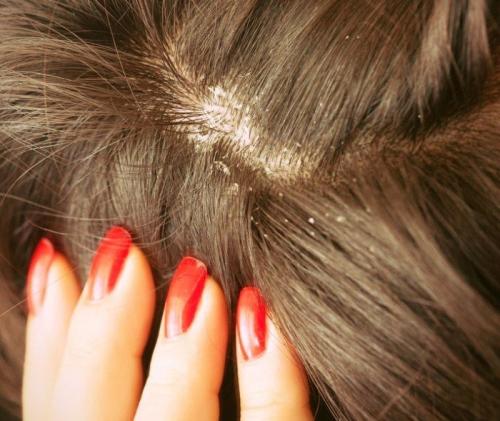 Как избавиться от перхоти. Рекомендации трихологов: как раз и навсегда избавиться от перхоти