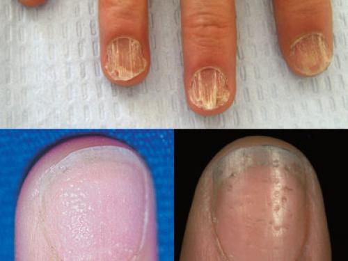 Очаговая алопеция у девушек. Симптомы гнездной алопеции