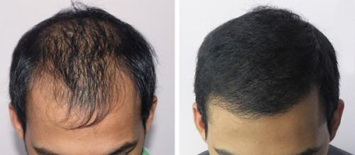 Почему выпадают волосы у мужчин. Почему подобное происходит