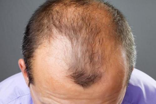 Слабые волосы у мужчин. Классификация болезни