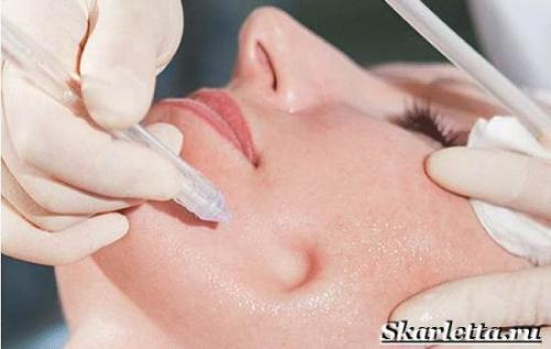 Газожидкостный ПИЛИНГ цены. Газожидкостный ПИЛИНГ. Описание, особенности, виды и цена газожидкостного пилинга