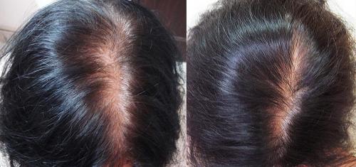 Газожидкостный ПИЛИНГ для волос. ГАЗОЖИДКОСТНЫЙ ПИЛИНГ КОЖИ ГОЛОВЫ: лечебный “душ” XXI века 08