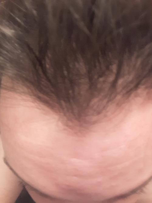 Как избавиться от перхоти форум. Как я избавился от перхоти. (Вдруг кому-то тоже поможет)