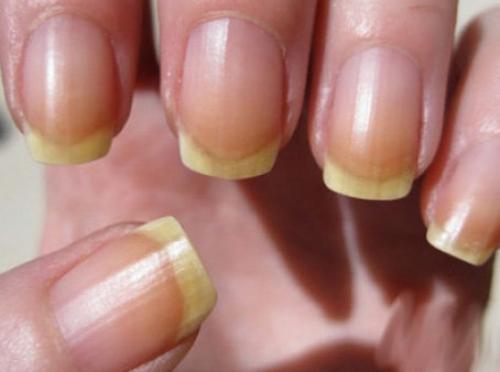 Лечение тонких и ломких ногтей. Как по ногтям определить, чего в организме не хватает и исправить ситуацию: ногти секутся, ломаются, слоятся, желтеют и т.п.
