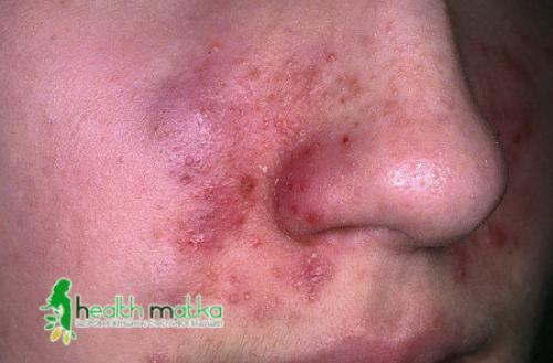 Себорейный дерматит. Патогенез себорейного дерматита