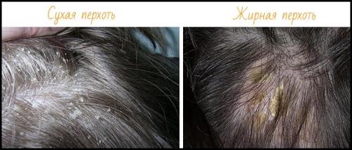 Как избавиться от перхоти. Рекомендации трихологов: как раз и навсегда избавиться от перхоти