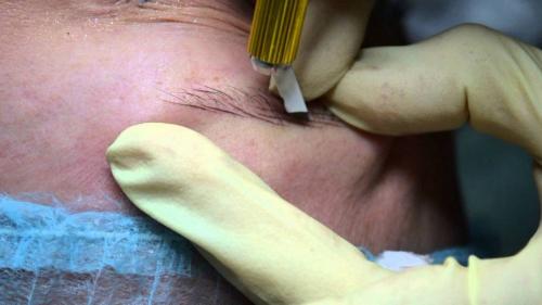 Микроблейдинг частично. ЧТО ТАКОЕ „МИКРОБЛЭЙДИНГ“?