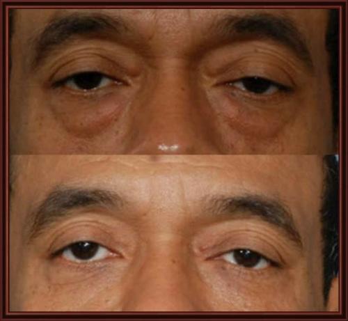 Как избавиться от мешков под глазами у мужчин. Причины патологии