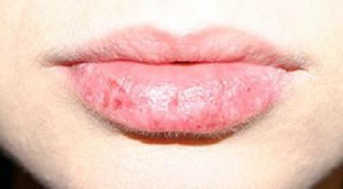 Трескаются и сохнут губы причина. Почему сохнут губы 01 Трескаются и сохнут губы причина. Почему сохнут губы 01