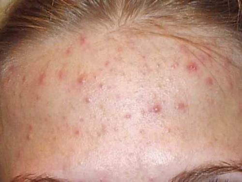 Маска для лица в домашних условиях для жирной. Жирная кожа лица - маски в домашних условиях и отзывы 01 Маска для лица в домашних условиях для жирной. Жирная кожа лица - маски в домашних условиях и отзывы 01