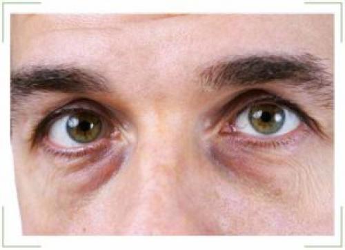 Темные круги под глазами у мужчин. Основные причины появления кругов под глазами