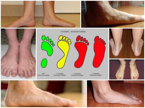 Какую обувь носить при плоскостопии мужчинам. Какую обувь носить при плоскостопии — советы по выбору и особенности тренировок при проблемах со стопами (110 фото)