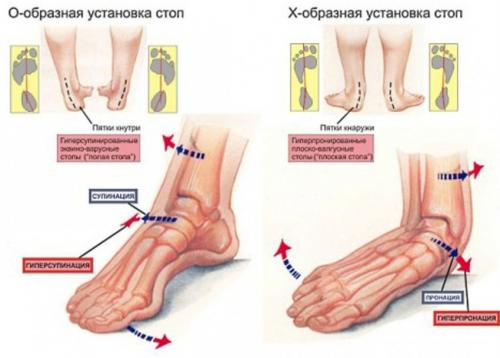 Какую обувь носить при плоскостопии мужчинам. Какую обувь носить при плоскостопии — советы по выбору и особенности тренировок при проблемах со стопами (110 фото)
