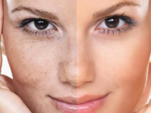 Маски отбеливающая для лица. Показания к применению 01 Маски отбеливающая для лица. Показания к применению 01