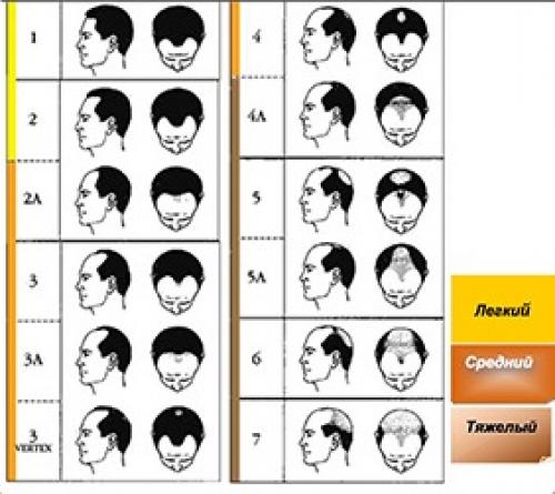 Как отрастить волосы на залысинах. Зоны и стадии облысения при мужской алопеции