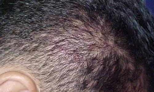 Жирная кожа головы и выпадение волос. Причины и виды возникновения заболевания