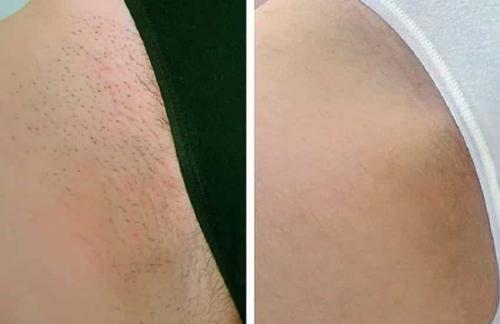 Лазерная эпиляция бикини. Сколько сеансов нужно для удаления волос навсегда