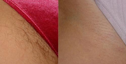 Лазерная эпиляция бикини. Сколько сеансов нужно для удаления волос навсегда