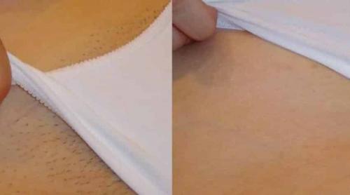 Лазерная эпиляция бикини. Сколько сеансов нужно для удаления волос навсегда