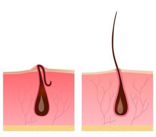 Чтобы никакого раздражения и врастания. Предпосылки и зона риска 03 Чтобы никакого раздражения и врастания. Предпосылки и зона риска 03