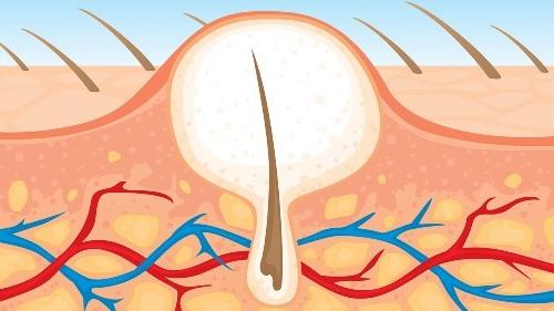 Чтобы никакого раздражения и врастания. Предпосылки и зона риска 04 Чтобы никакого раздражения и врастания. Предпосылки и зона риска 04